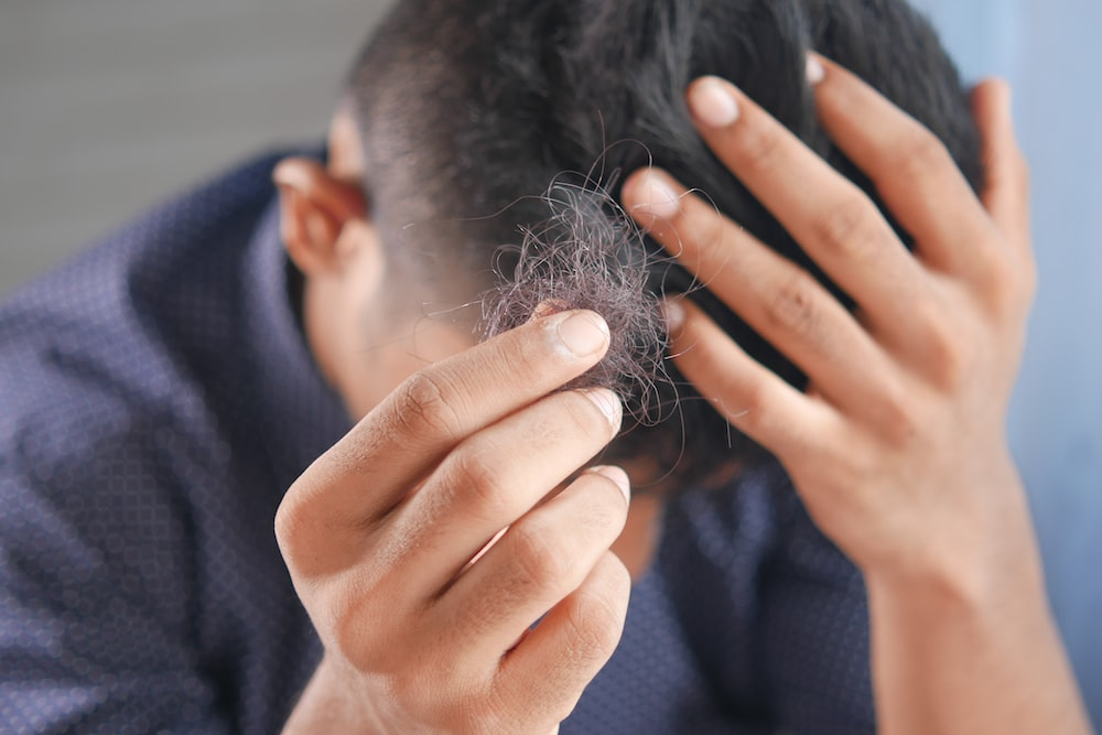  Treatment of Male Pattern Baldness